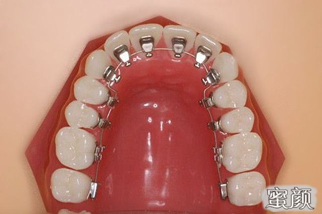 牙齿矫正器的种类和特点