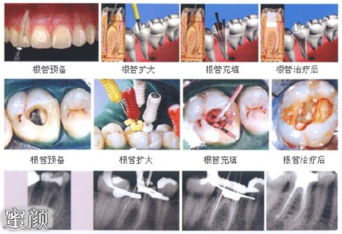 根管治疗是真牙的"救命稻草,很多人都知道自己的牙齿已经腐烂