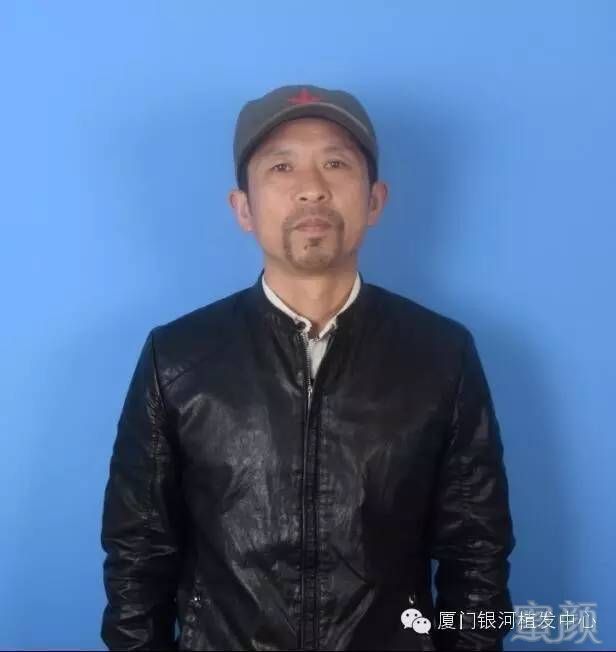 【银河案例】胡须种植,让男人更性感更有男人味!