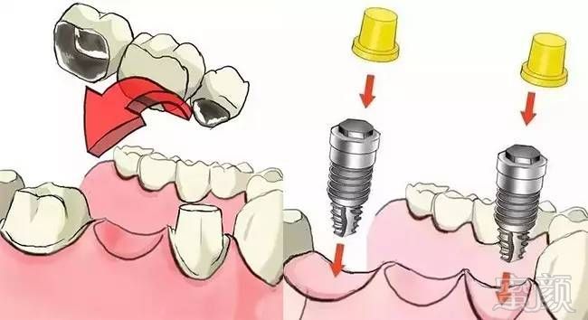镶牙和种牙有什么区别 ?