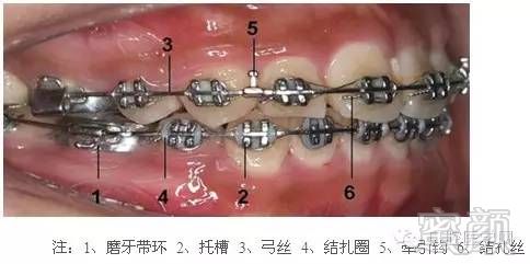 塞牙齿之间,几天之后就会使牙齿之间出现微小的间隙,然后才能将带环