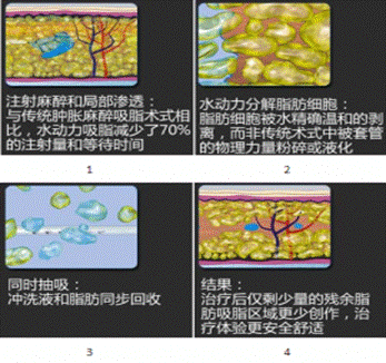 水动力吸脂工作原理