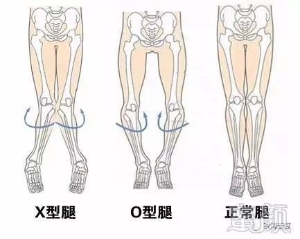 摆脱o型腿,秀出你的美