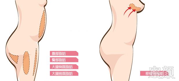 【天津自体脂肪隆胸】自体脂肪隆胸 纳米微创 安全性感 高成活率 男神