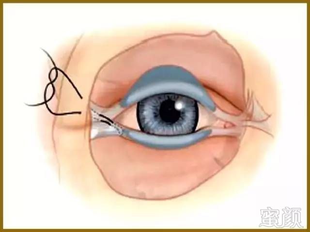 「整外干货」眼睑成形术与眉提升术概述