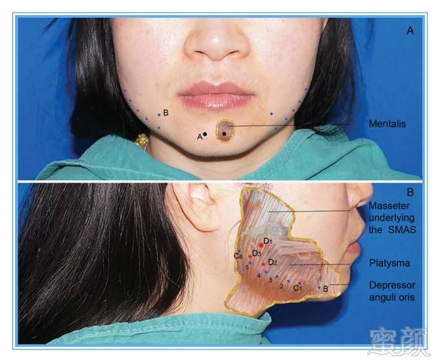 下颌多区域肉毒素"微注射" 不仅仅是瘦脸,还可以突出颏部和提升面部