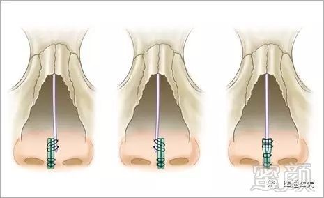 鼻中隔延长术---让鼻子变得更美的魔术