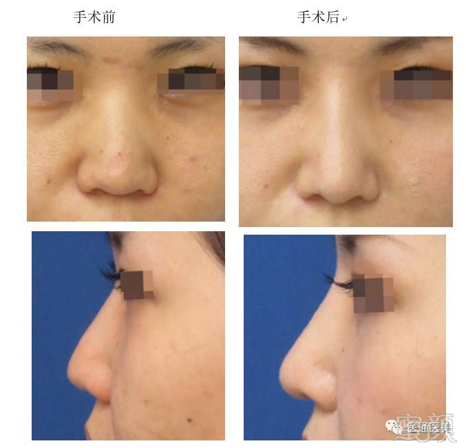 跟单纯的移植软骨手术不同,它是是改善鼻腔结构的手术.
