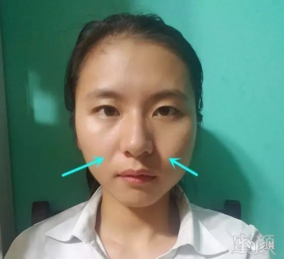 妹纸一看年纪就不大,满脸的胶原蛋白既视感,可惜整张脸下垂的很严重