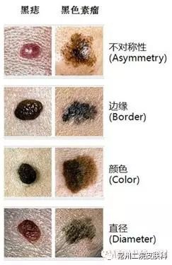 5,尽量避免损伤黑痣,损伤是一种炎性刺激,也是黑色素瘤的诱因.