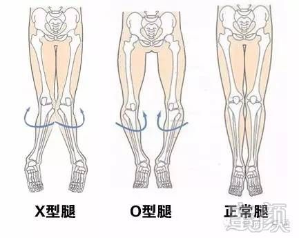 (x型腿与o型腿都属于腿型问题,其原理与矫正方法基本一样)下面为o/x型