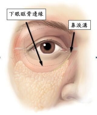 这样,眼下就会有一些凹陷.