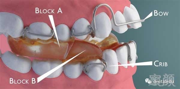 儿童下颌后缩的矫正-之经典twin block