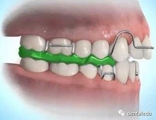 故应调磨上颌颌垫远中处,保证下颌磨牙与牙合平面有1mm左右间隙,利于