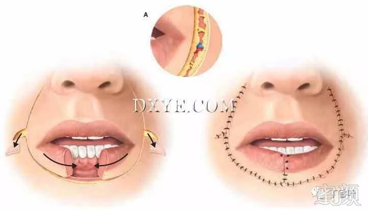 1853年描述的用于下唇重建的原始bernard唇成形术已经被修改了很多次