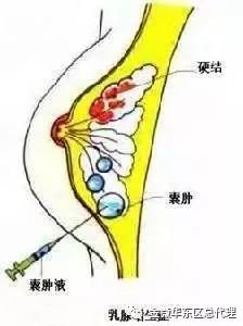 腋下是淋巴循环的重要地带,乳房,副乳分泌出的代谢物,毒素都将有淋巴