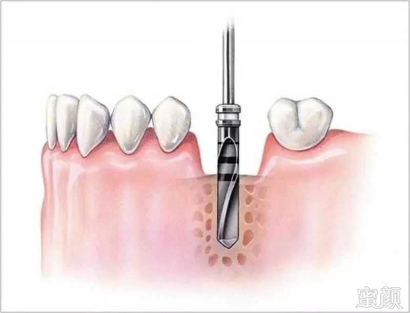 种植牙手术过程介绍