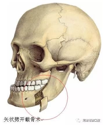包含牙列的骨断与周围离断,这样我们就能够将上下颌骨摆到正常的位置