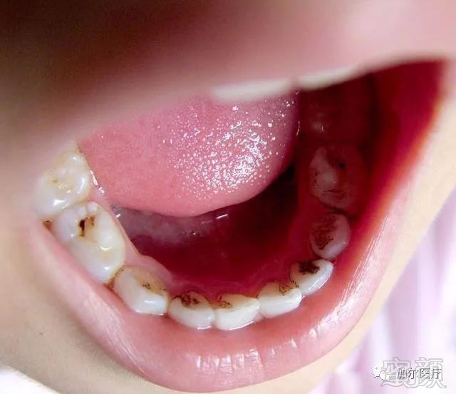 和牙菌斑,你所看到的变白其实是牙齿排列不齐所致,一旦有深色素沉着