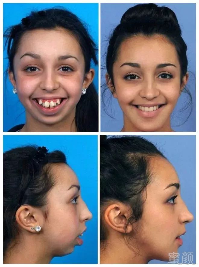 jones)在14岁的时候,就被发现有天生颌骨畸形,导致牙齿严重缺陷,她