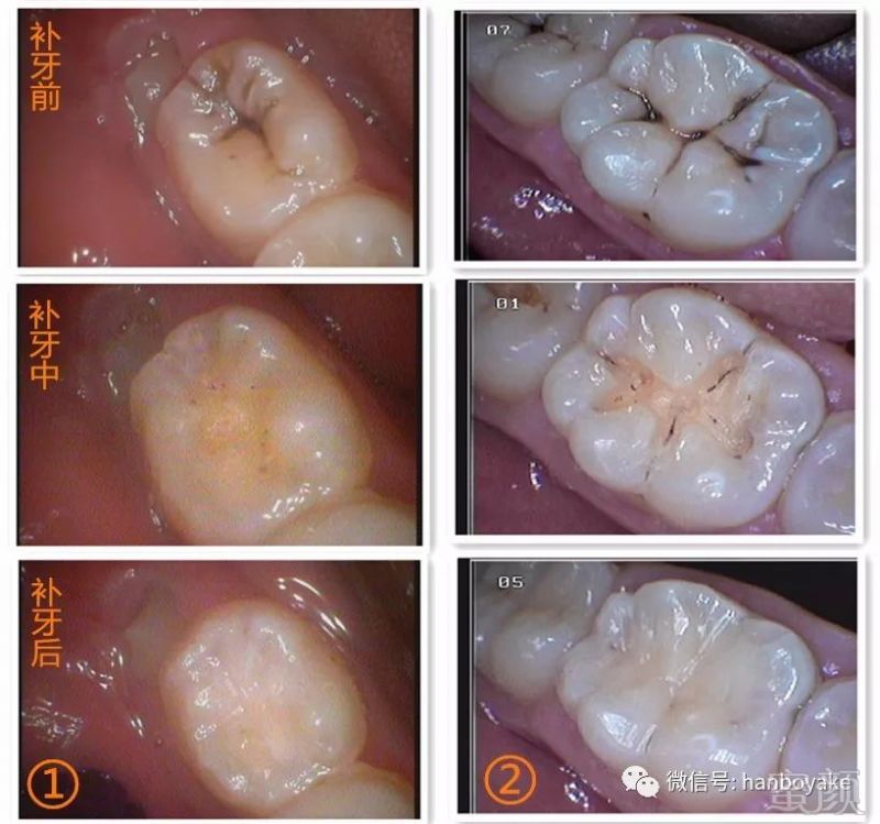 医生将根据不同程度的龋齿或缺损,制定相应的修补计划,恢复牙齿的形态