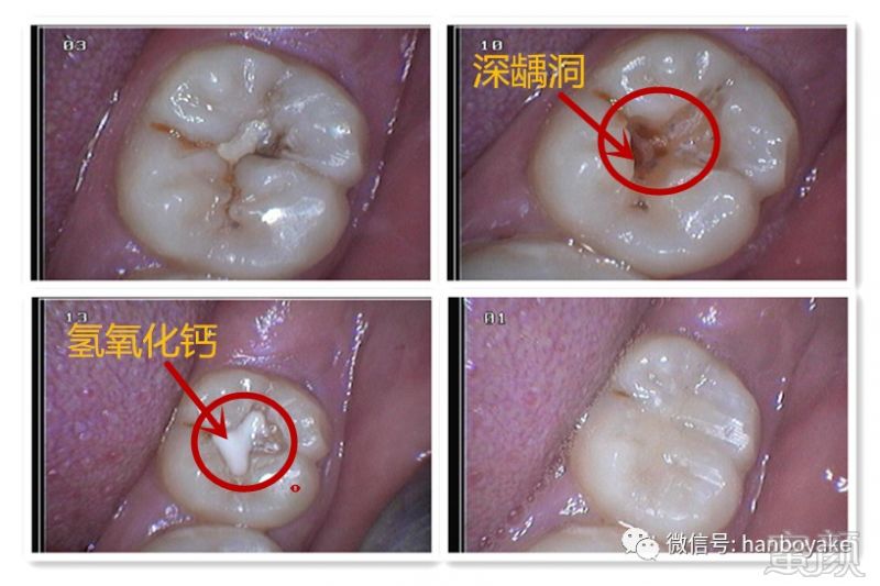 图④邻接面龋通常深龋的牙齿,均需通过x光片辅助诊断,若已侵入牙髓,则