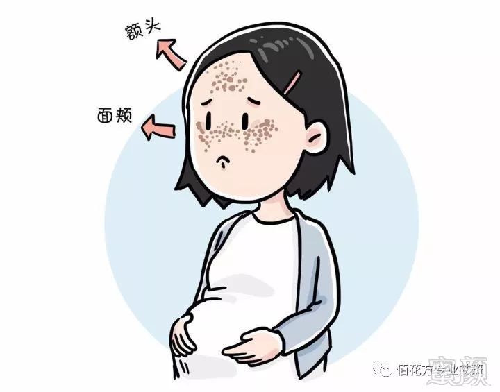 为何黄褐斑被称为"孕妇脸上的面纱"?