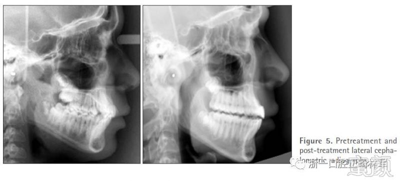 正畸病例赏析--多学科联合治疗上颌融合中切牙