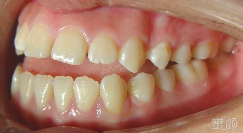 经常咬唇导致上前牙过度生长,     从而造成牙齿不齐,龅牙