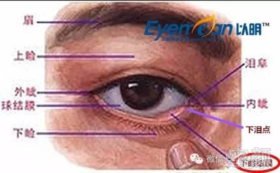 2,确保贴附于角膜结膜的睫毛在孩子闭眼时是脱离角膜结膜的.