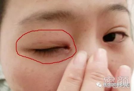 割双眼皮落下疤痕如何修复?