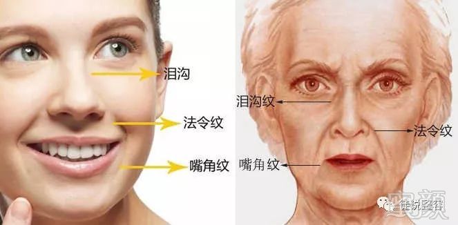 泪沟,鼻唇沟,木偶纹…… 如何去除这些该死的三八线?