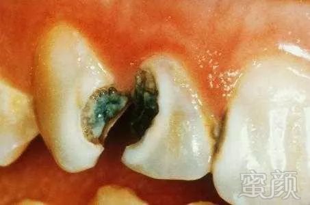 龋齿,俗称蛀牙,是由于残留在牙齿表面的食物在细菌的作用下产酸