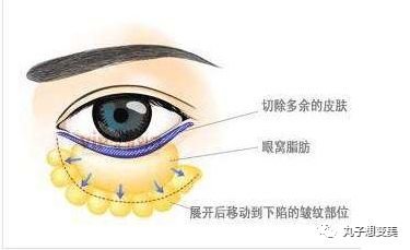 瑞妍茗医:网红蕞爱的眼睑下至是什么样的手术