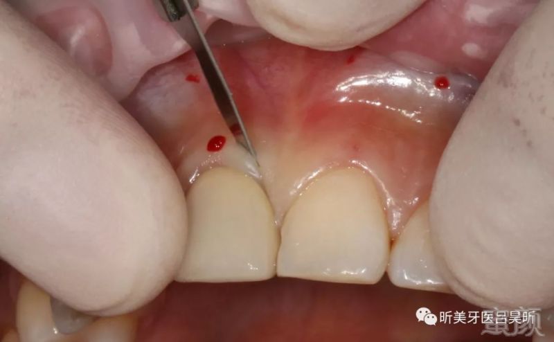 根据不同牙齿的长宽比进行牙龈切除定点