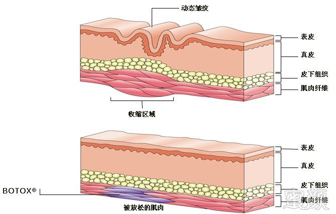 解决动态皱纹             肉毒素除皱原理是"软化".