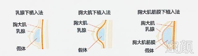 1.乳腺下假体植入