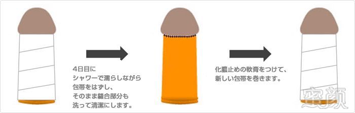 02   参考价格    包皮系带切除:15万(同时去包皮 10万)   阴茎増