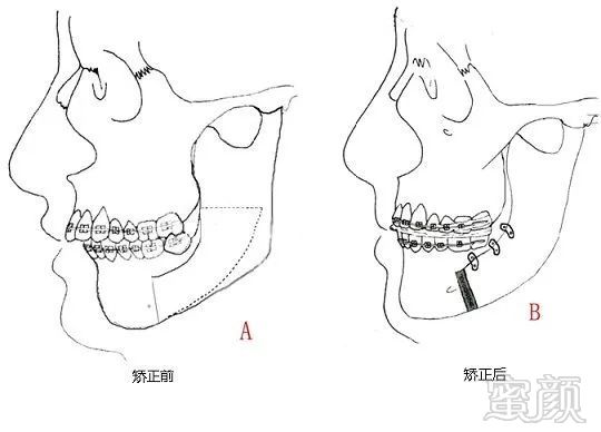 凤姐的正颌手术需要上图中上颚下颚同时截骨,调整正确美观的咬合