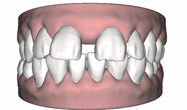 牙缝大的矫正动图     3.牙齿前突,龅牙