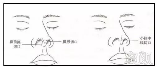 隆鼻的疤痕与切口位置有关     常见的有