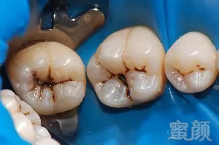 4颗大牙都长有黑线,为什么牙医不让补牙?