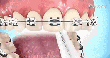 牙齿矫正期间应该怎样刷牙?