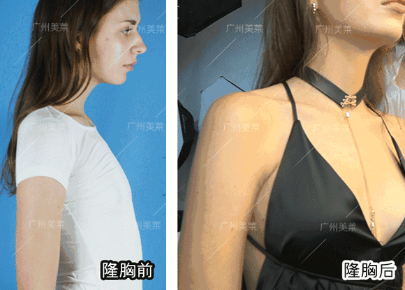 隆胸后,连照片都装不满她的胸啦!