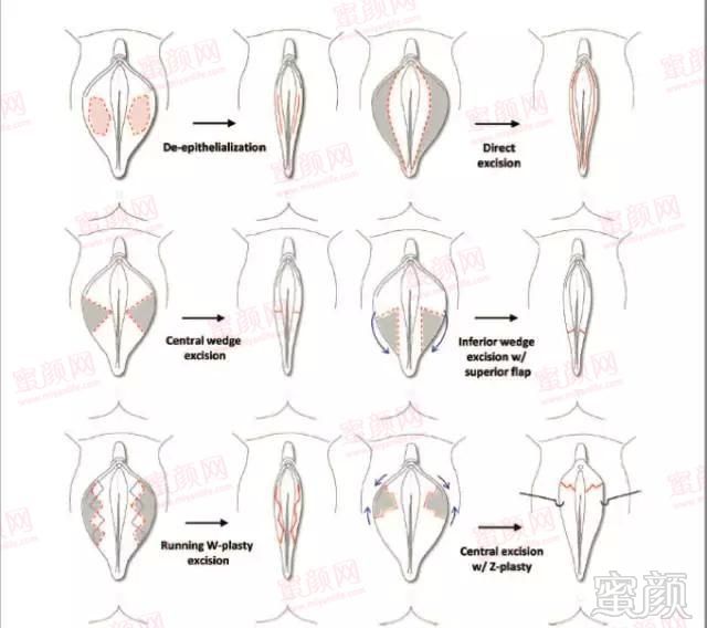 探秘30种女性外阴形状分类,是男人都收藏了!