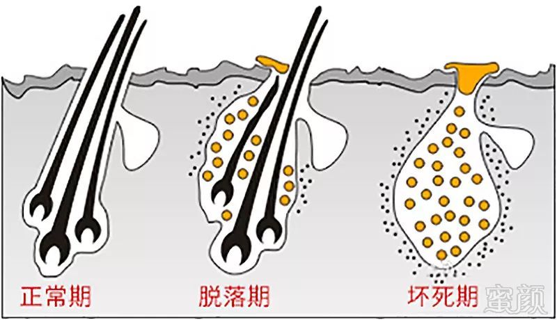 治疗脱发白发前为什么要做毛囊检测呢