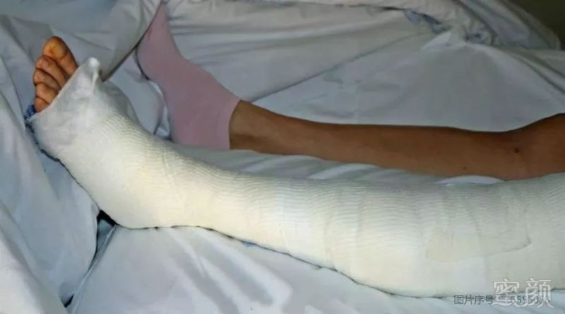 15岁小女孩为治o型腿,打断9处骨头拉直腿!