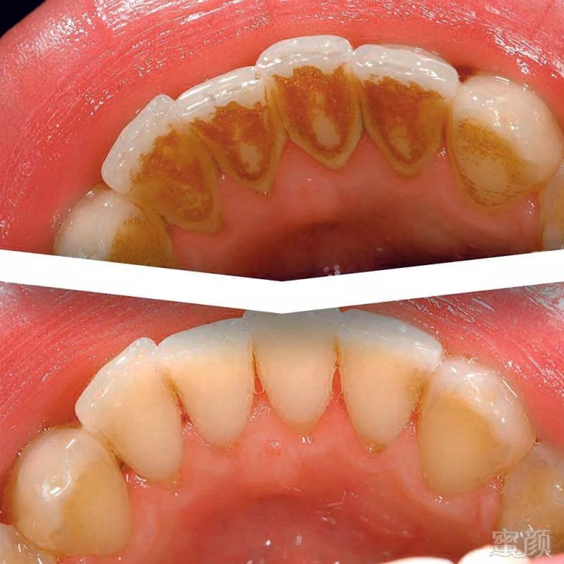 变成这样    你大半辈子没洗,积累了大量牙结石的牙,  可以从这样