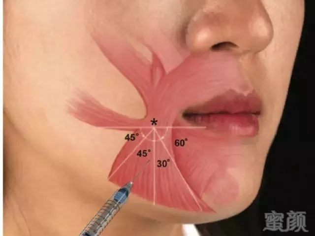 把肉毒素注射到唇下方降口角肌,     使牵引嘴角向下的肌肉力量