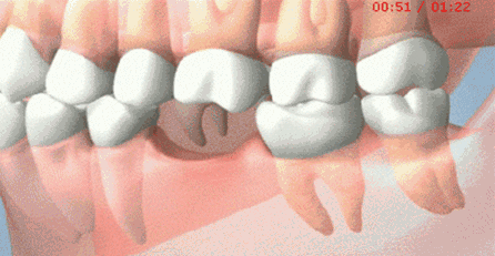 牙列的完整性遭到破坏牙齿缺失后,领近的牙齿由于失去了依靠和约束,会
